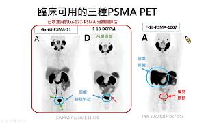 Appropriate use criteria for PSMA PET黃玉儀醫師 [upl. by Drisko]