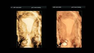 ultrasonography of the myometrium [upl. by Nylorac]