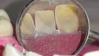 Anterior teeth preparation  U1 by  Ahmed Adnan Albhaisi [upl. by Aubine]