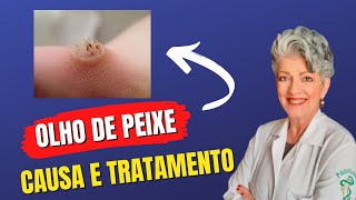 OLHO DE PEIXE  Saiba qual é a CAUSA e os melhores TRATAMENTOS [upl. by Otreblon]