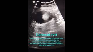 Dermoid cyst [upl. by Mori993]