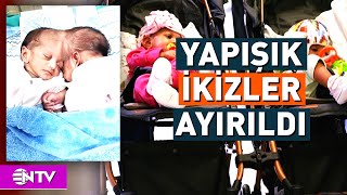 Yapışık İkiz Bebekleri Ayırmak İçin 14 Saatlik Operasyon  NTV [upl. by Edholm485]