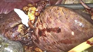 Central hepatectomy HCC [upl. by Tarsuss219]