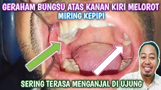 Geraham Bungsu Atas Kiri Kanan Tumbuh Melorot Dan Miring Kepipi [upl. by Acinot]