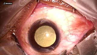 Intravitreal Triamcinolone Acetonide Injection IVTA by Dr Ravi B [upl. by Nollid460]