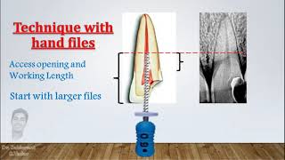 Crown Down preparation for Anterior teeth Wide canals [upl. by Olympie]