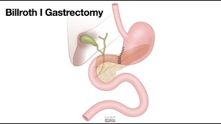 HCC 147510bSurgical AnatomyBillroth I [upl. by Llenna699]