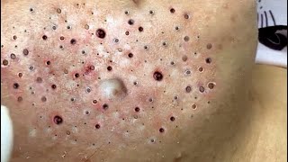 Relax Skincare Everyday with Acne Blackheads Treatment Spa 98083 [upl. by Allare]