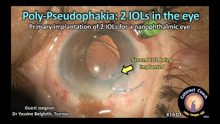 CataractCoach 1610 poly pseudophakia 2 IOLs in the eye [upl. by Allimac]