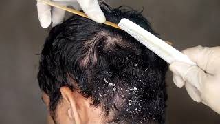 Dandruff Scratching My Husband Has Big Flakes  NO TALKING Pt 11  Hair Cleaning [upl. by Yellek]