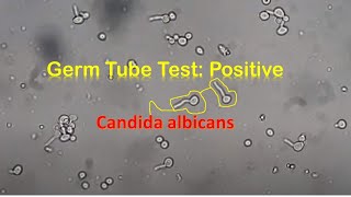 Germ Tube Test Positive Candida [upl. by Jsandye]