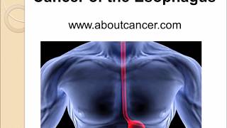 Esophagus Cancer [upl. by Terina]