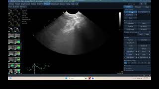 IQ 298 TFAST LUNG B LINE PULMONARY EDEMA HWD ECHOPAC ANALYSIS [upl. by Wellington558]