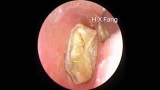 NO2023092301Ear wax removalFungus cleaning 耳垢清除和真菌清理 [upl. by Eiahpets916]