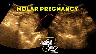 Molar Pregnancy  Hydatidiform Mole  Gestational Trophoblastic Disease  Ultrasound  Case 38 [upl. by Tamqrah]