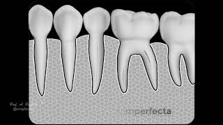 Dentinogenesis imperfecta [upl. by Falconer]