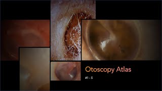 Otoscopy Atlas [upl. by Esoj]