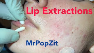 Lip extractions Whiteheads blackheads acne extractions on face Inflammatory pustules [upl. by Gunnar]