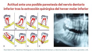 Posible PARESTESIA del NERVIO DENTARIO INFERIOR tras extracción quirúrgica del TERCER MOLAR INFERIOR [upl. by Airamasor]