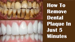 How To Remove Dental Plaque In Just 5 Minutes  Remove Tartar On Teeth FAST HealthyPunchToday [upl. by Esilana341]