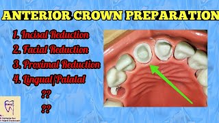 Crown Preparation for anterior  Crown cutting [upl. by Klein319]