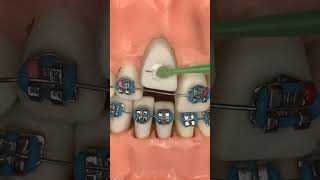 Orthodontics procedure brases bracket fixed music safe ☝️🤔❤️ [upl. by Tsew]