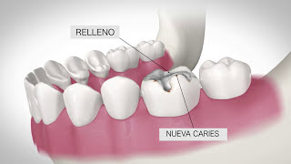 ¿Qué es una Corona Dental Precio corona dental de Zirconio [upl. by Benildas521]