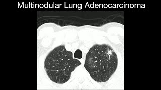 Multinodular Lung Adenocarcinoma [upl. by Anauqed491]