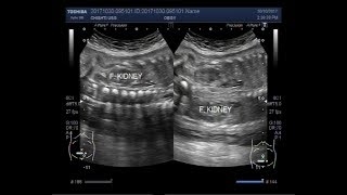 Ultrasound Video showing a fetus with distended urinary bladder and bilateral renal hydronephrosis [upl. by Moyra918]