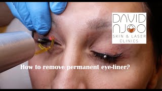 How to remove permanent eye liner using the Picoway laser [upl. by Horvitz]