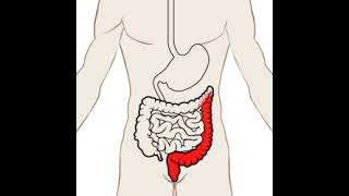 Where does Pancolitis occur in the bowel [upl. by Grannia]