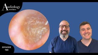 EPIC SKIN PEEL amp IMPACTED EAR WAX REMOVAL  EP789 [upl. by Pius]