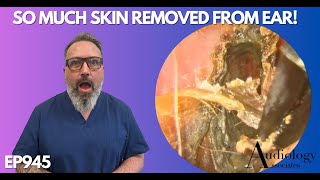 SO MUCH SKIN REMOVED FROM PATIENTS EAR CANAL  EP945 [upl. by Brosy]