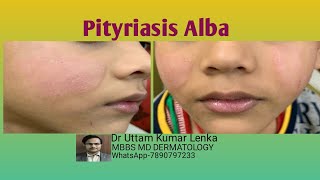 What is Pityriasis alba चेहरे में सदा दाग का इलाज  white spots on face  dr uttam lenka [upl. by Nnylylloh]