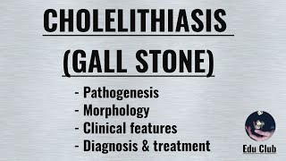 Cholelithiasis Gall Stone  Cholesterol stone  Pigment stone [upl. by Aipotu]