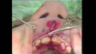 2a Diastema Closure and Frenectomy With Z Plasty [upl. by Appleton]