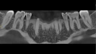 Submandibular gland depression mimicking a dental abcess [upl. by Scherle]