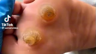 HUGE HARD SKIN REMOVAL WHY DOES THIS HAPPEN [upl. by Odine]