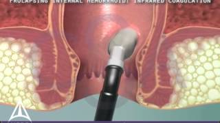 Infrared Coagulation Therapy for Hemorrhoids  3D Medical Animation [upl. by Luhey]