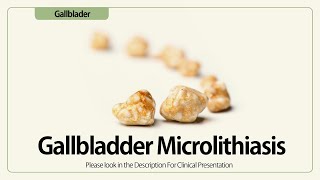 Linear EUS Gallbladder Microlithiasis [upl. by Thgiwd]