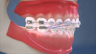 Class II Elastics  Lateral View HD Edition [upl. by Atsylak]