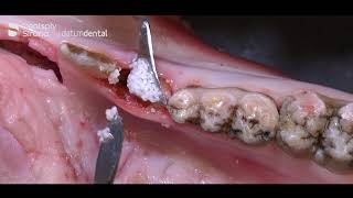 Socket preservation demonstration using Bone Graft amp OSSIX® Plus [upl. by Neersan]