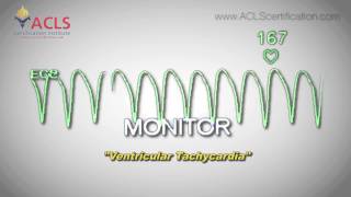 Ventricular Tachycardia by ACLS Certification Institute [upl. by Kerns]