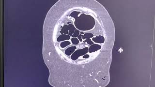 Small bowel obstruction  cause adhesions  search for the stenotic  transitional point [upl. by Zetnom]