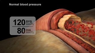 High Blood Pressure Diagnosis  NUCLEUS Medical Media [upl. by Cordy100]