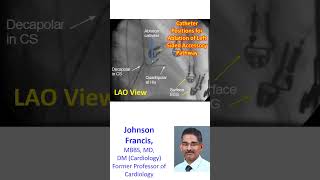 Catheter Positions for Ablation of Left Sided Accessory Pathway [upl. by Ailegave]