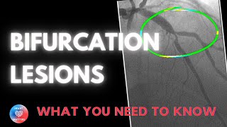 Bifurcation Coronary Lesions [upl. by Dick]