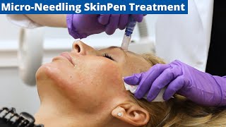 MicroNeedling Skin Pen Treatment amp Benefits [upl. by Yclehc]