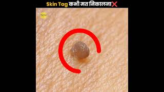 Skin Tag कभी मत निकालना ❌  Never Remove Skin Tag  The Fact  shorts ytshorts [upl. by Lady]