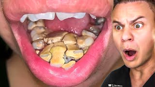 Orthodontist Reacts To Disgusting Teeth Cleanings [upl. by Odnamla]